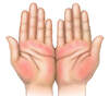 With palmar erythema, the redness is most prominent in the thenar and hypothenar eminence, with sparing of the central region of the palm.