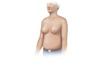 In men with cirrhosis, benign enlargement of the breasts may occur and manifest as gynecomastia.