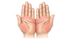 The palmar erythema is most prominent in the thenar and hypothenar eminence, with sparing of the central palm.